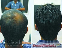 Hair loss Solution